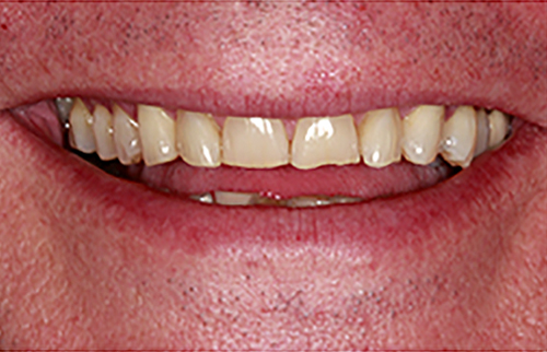 Before Image: Smile - front