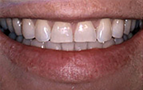 Before Image: Smile - front