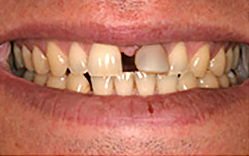 Before Image: Smile - front