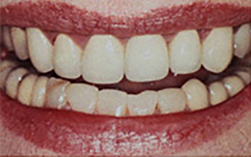 Before Image: Smile - front