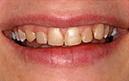 Before Image: Smile - front