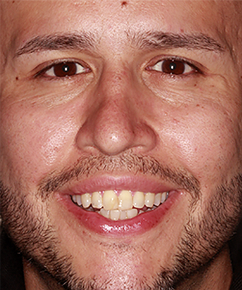 Before Image: Smile - front